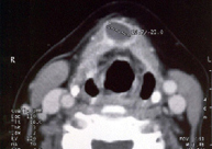 Quiste del conducto tireogloso_2