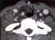 Quistes paratiroideos