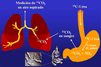 Test del aliento para Helicobacter pylori con urea C13