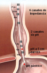 Impedanciometría intraluminal multicanal esofágica