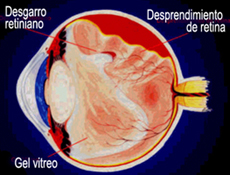 Desprendimiento de retina