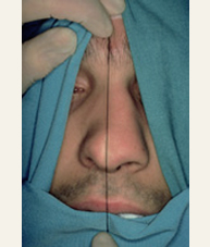 Septoplastia2