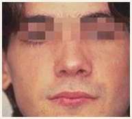 septoplastia-despues