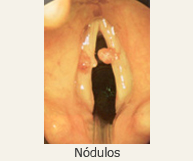 Nódulos