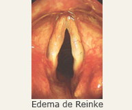 Edema de Reinke