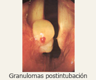 Granulomas postintubación
