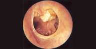 Colesteatoma