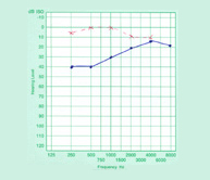 Perforación tímpano2