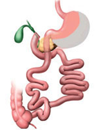switch duodenal