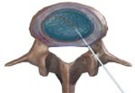 Tratamiento quirúrgico percutáneo minimamente agresivo