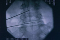 Tratamiento quirúrgico percutáneo minimamente agresivo_2