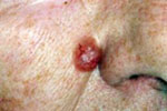 Carcinoma basocelular