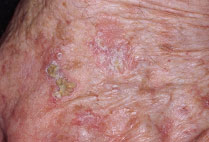 Queratomas actínicos en el dorso de la mano de una persona de piel clara.