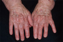 Detalle de queratomas actínicos