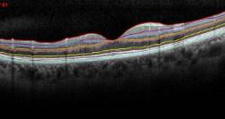 Meeting-del-European-Glaucoma-Panel-en-Londres---Diciembre-2014