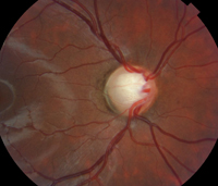 El diagnóstico precoz