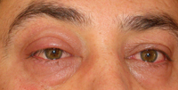 Conjuntivitis