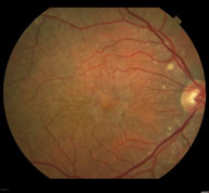 Membrana epirretiniana macular