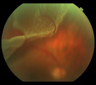 Desprendimiento de retina2