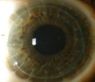 Opacidad corneal