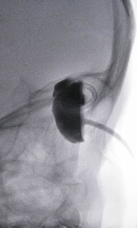 Linfangiomas orbitarios