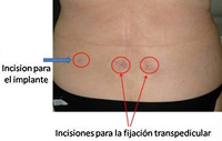 Incisiones post-quirúrgicas de menos de 12 mm en una paciente