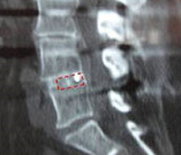 implante endoscópico en L4/L5 para expandir pinzamientos discales sin necesidad de recurrir a la cirugía abierta