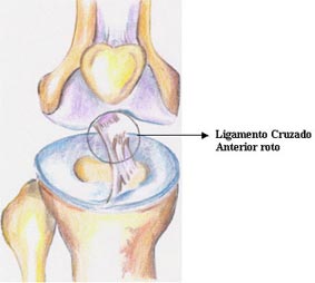 Ligamento Cruzado Anterior Rotura