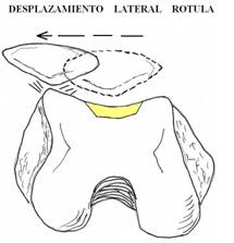 Rótula desplazada hacia afuera