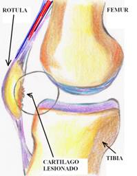 Lesión del cartílago rotuliano