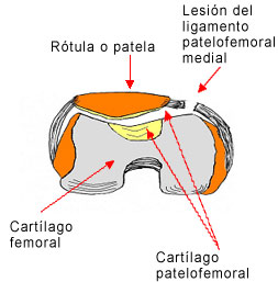 Rótula - ligamento patelofemoral
