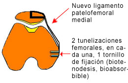 Rótula - ligamento patelofemoral 3