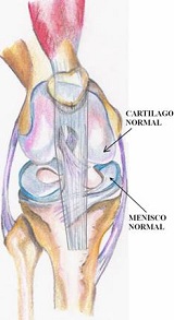 Artrosis-protesis_peq