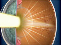 Dispersión lumínica en catarata