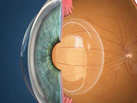 Lente intraocular pseudofáquica como sustituto del cristalino