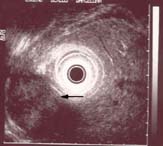 Tumores submucosos del tubo digestivo