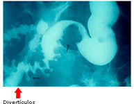 Divertículos