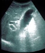 Diagnóstico y tratamiento de la litiasis biliar