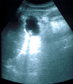 Diagnóstico y tratamiento de la litiasis biliar