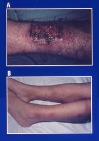 Enfermedad inflamatoria intestinal