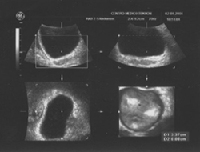 Ecografia en 3 dimensiones de la vejiga urinaria