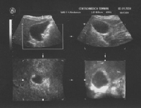 Ecografía 3-D de la vesícula biliar