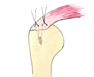 Suturas anudadas y manguito rotador reinsertado