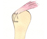 Segundo anclaje a la cara lateral humeral