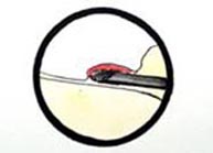 Imagen artroscópica