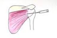 Infiltración de la articulación con corticoides