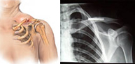 Fracturas de la clavícula
