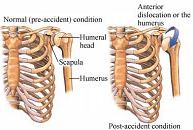 Luxación glenohumeral