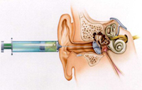 Tratamiento con gentamicina intratimpánica
