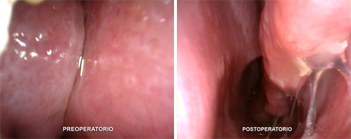 Cornetes preoperatorio y postoperatorio